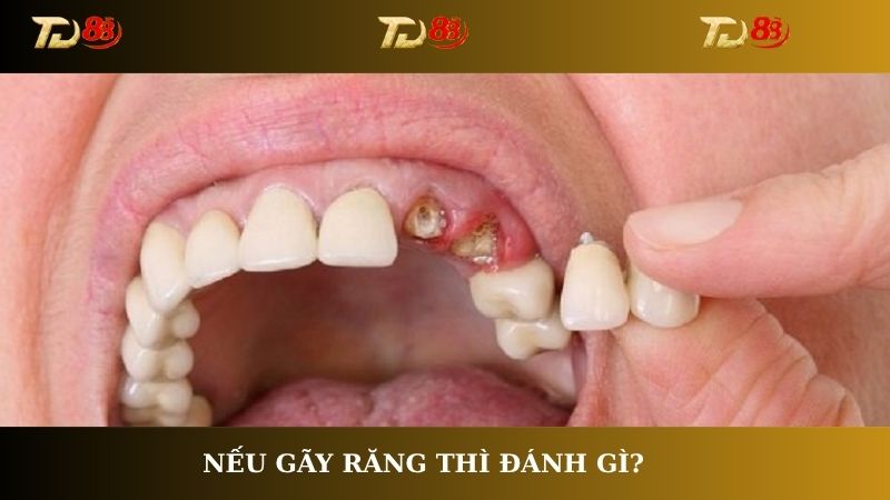 Nếu gãy răng thì đánh gì?